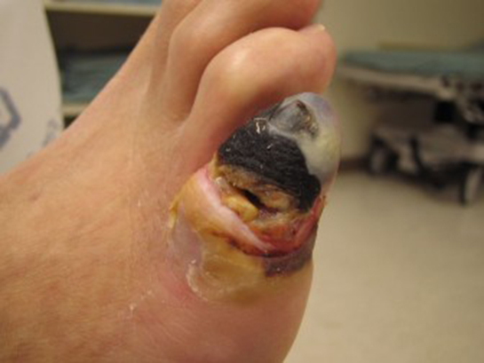 Ayakta Kangren Belirtileri ve Tedavisi