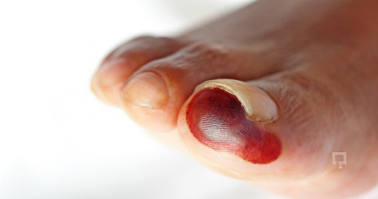 Kangren Belirtileri ve Tedavisi