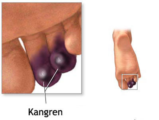 Kangren Belirtileri ve Tedavisi