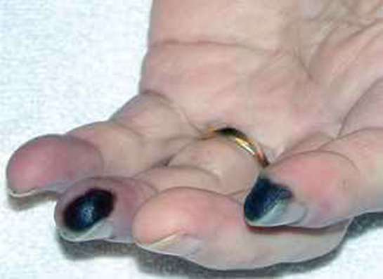 Kuru Kangren Tedavisi