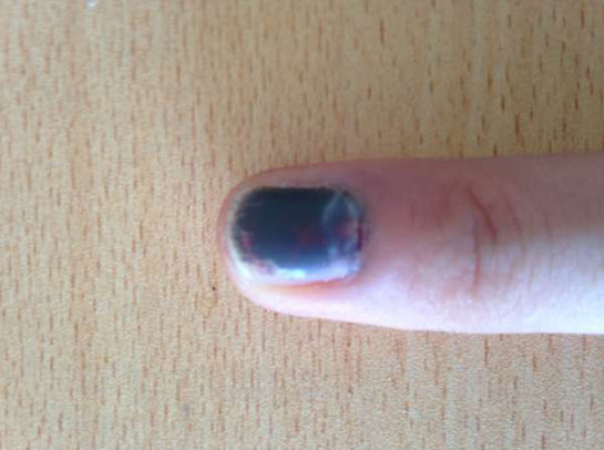 Tırnak Batması Kangren Belirtileri ve Tedavisi